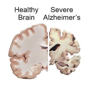 https://neuro.gatech.edu/sites/default/files/Hg_News/Alzheimers.pTau_.Data__0.jpg