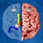 https://neuro.gatech.edu/sites/default/files/Hg_News/thumbs/Deep_Brain_Stimulation.jpg